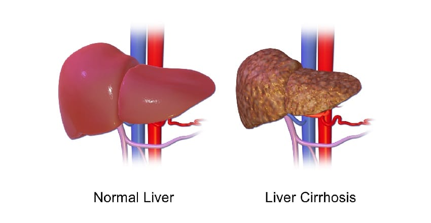 ayurveda fatty liver treatment