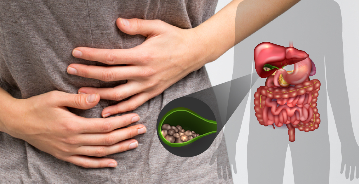 Traditional Ayurvedic herbs used for gallbladder stone treatment
