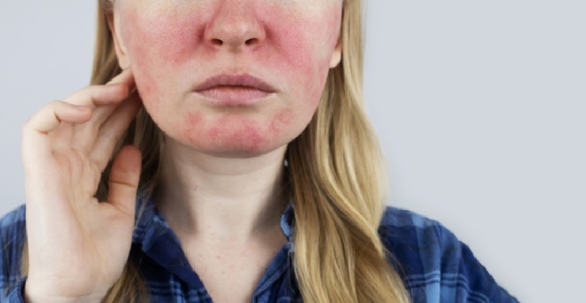 ­­­­Rosacea Treatment: An Ayurvedic Perspective